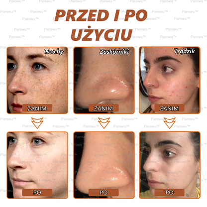 ✨Parowu™ Wybielająca i Rozjaśniająca Maska - Naturalne składniki trwale usuwają plamy, piegi i przebarwienia🔥🔥🔥