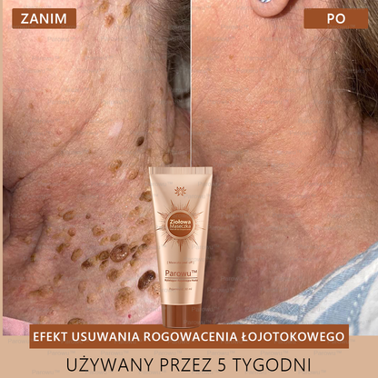 ✨Parowu™ Wybielająca i Rozjaśniająca Maska - Naturalne składniki trwale usuwają plamy, piegi i przebarwienia🔥🔥🔥