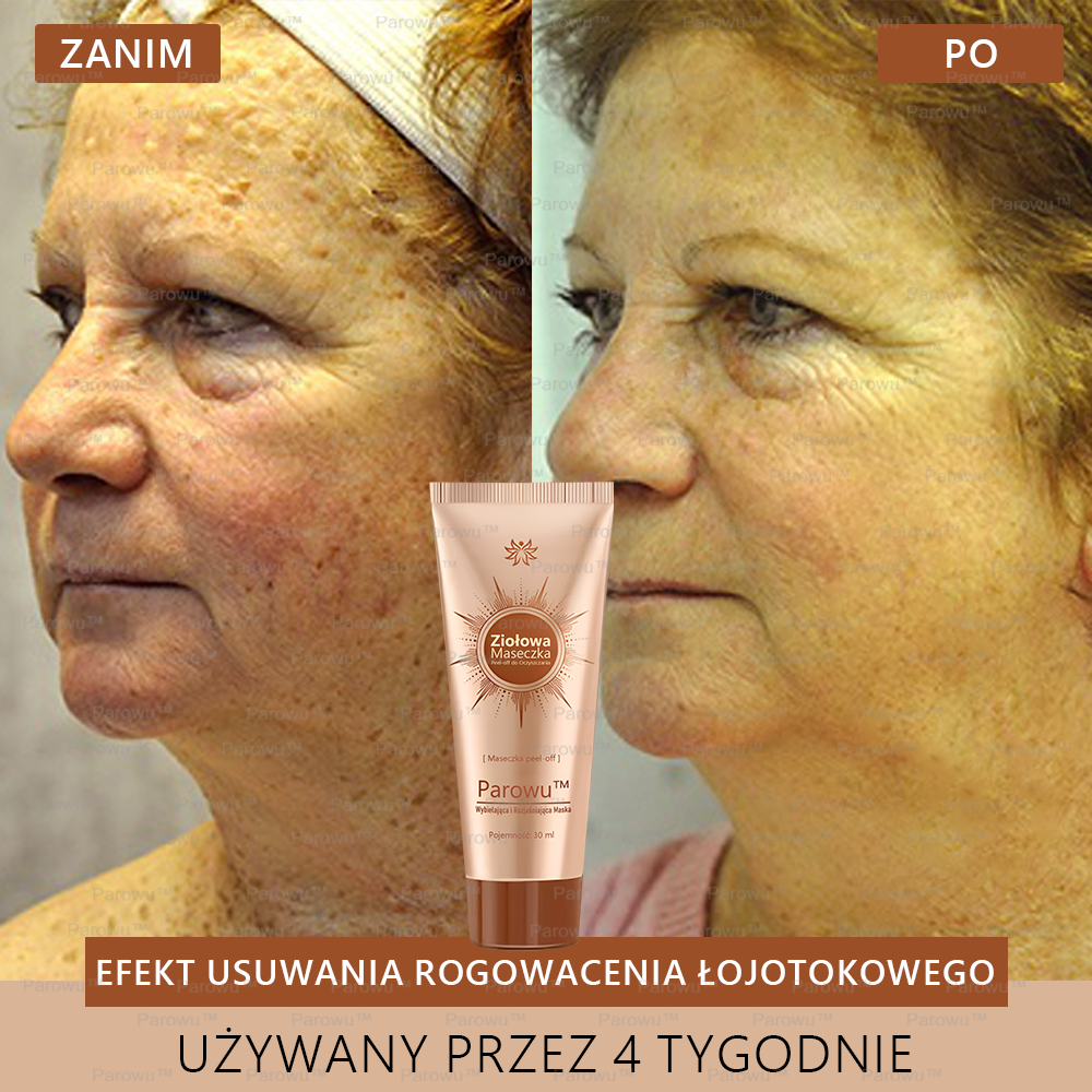 ✨Parowu™ Wybielająca i Rozjaśniająca Maska - Naturalne składniki trwale usuwają plamy, piegi i przebarwienia🔥🔥🔥